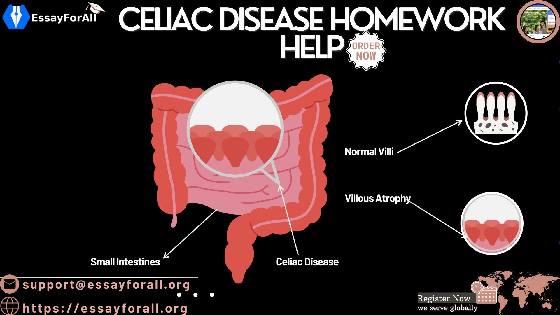 Celiac Disease Homework Help