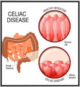 Celiac disease