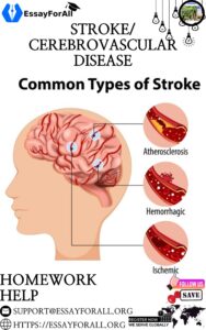 Stroke - Cerebrovascular Disease Homework Help